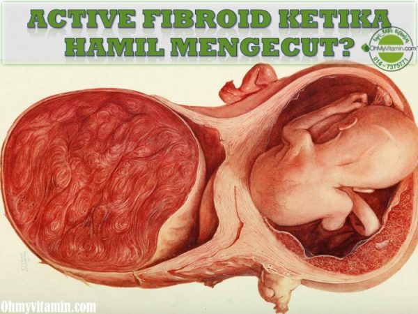 10 CM ACTIVE FIBROID MENGECUT KETIKA HAMIL