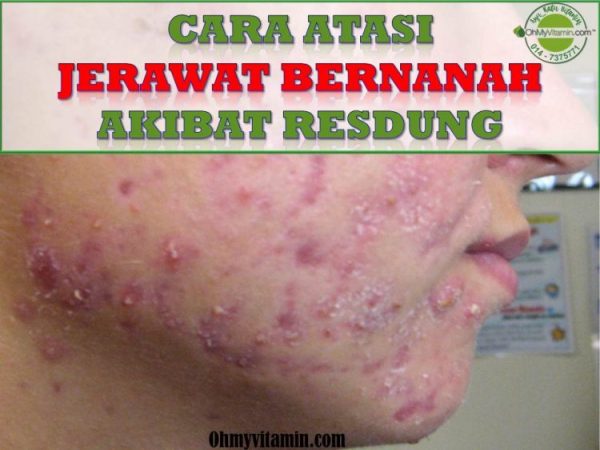 CARA ATASI JERAWAT BERNANAH AKIBAT RESDUNG DENGAN BERKESAN