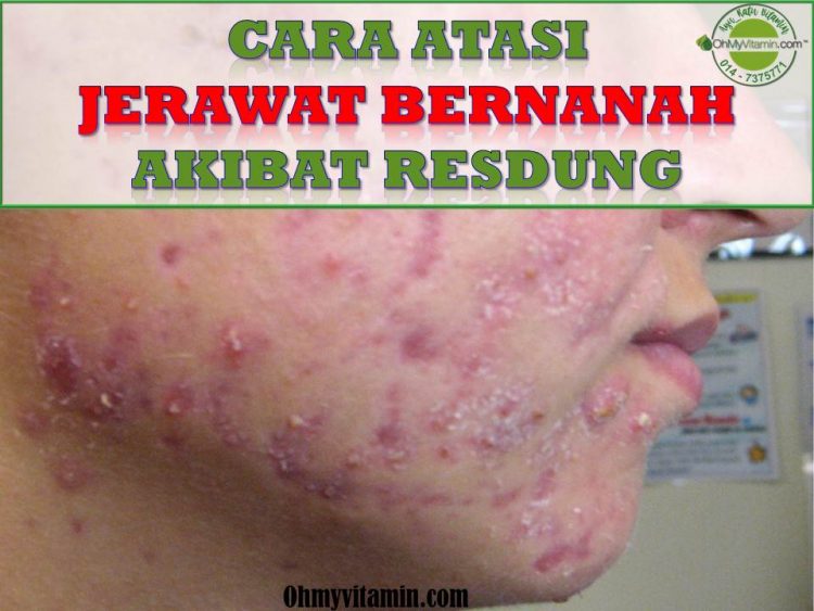 CARA ATASI JERAWAT BERNANAH AKIBAT RESDUNG DENGAN BERKESAN
