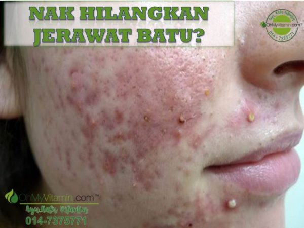 HILANG JERAWAT BATU SELEPAS AMALKAN POLIFENOL?