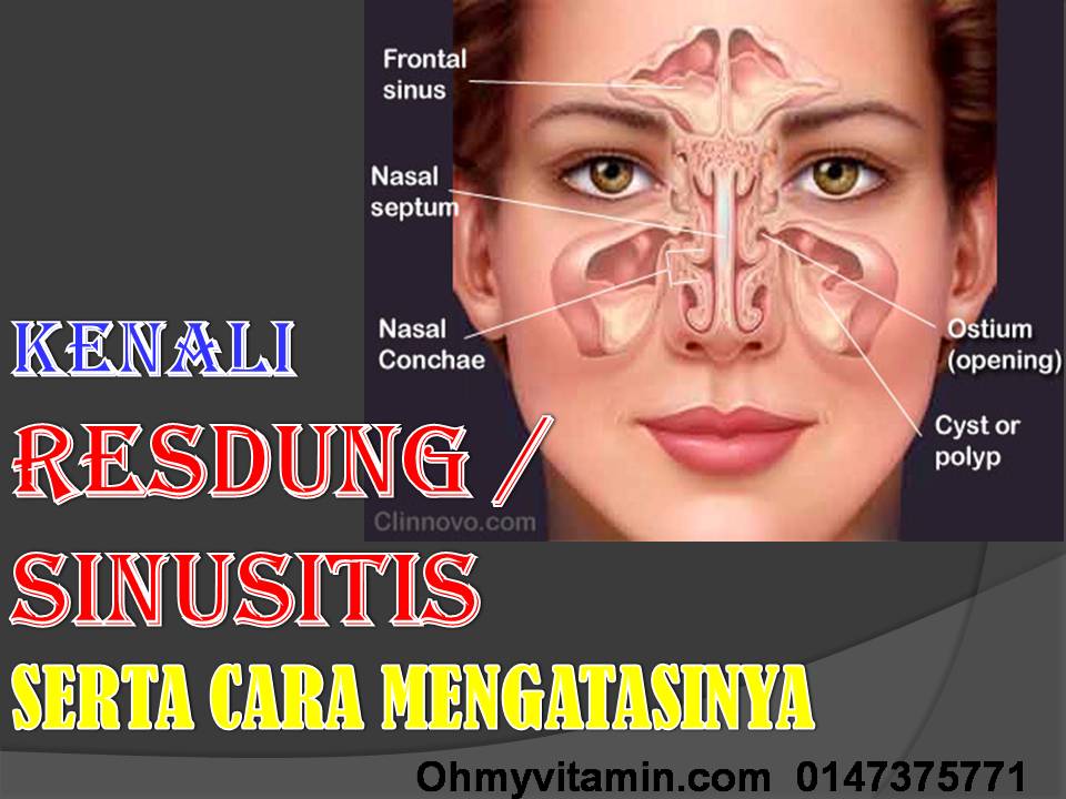 RESDUNG: PUNCA, CARA MENCEGAH, DAN CARA RAWATAN YANG BERKESAN UNTUK MENGATASI RESDUNG