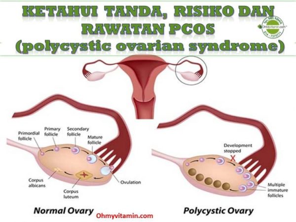 PCOS: APA TANDA, RISIKO DAN CARA RAWAT PCOS AGAR MUDAH HAMIL?