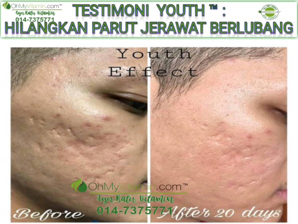 TESTIMONI HILANGKAN PARUT JERAWAT BERLUBANG SELEPAS 20 HARI DENGAN SKINCARE YOUTH™