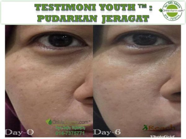 TESTIMONI JERAGAT PUDAR SELEPAS 6 HARI DENGAN SKINCARE YOUTH™