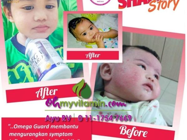 TESTIMONI OMEGA GUARD KURANGKAN RADANG EKZEMA ANAK