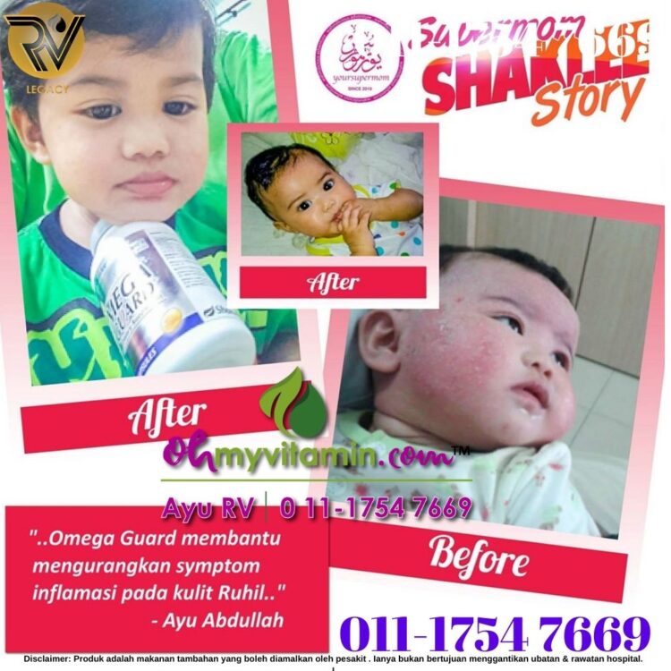 TESTIMONI OMEGA GUARD KURANGKAN RADANG EKZEMA ANAK