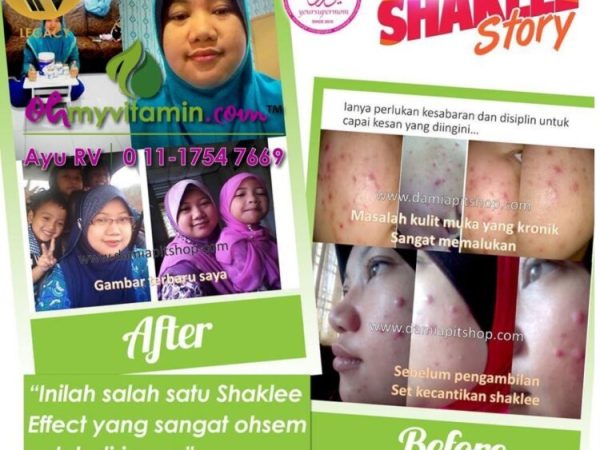 CARA MUDAH ATASI JERAWAT BERNANAH AKIBAT KULIT MUKA BERMINYAK