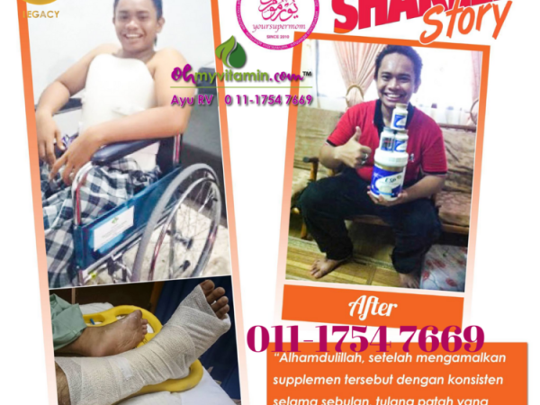 TULANG PATAH CEPAT PULIH SELEPAS AMALKAN SHAKLEE