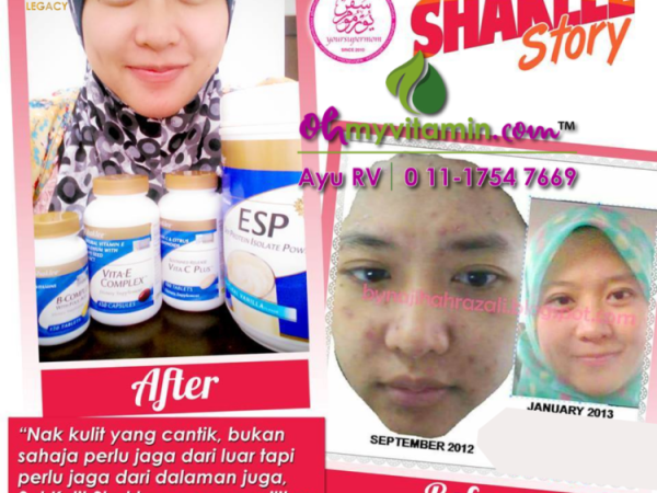 WANITA INI KONGSI CARA HILANGKAN PARUT CHICKEN POX